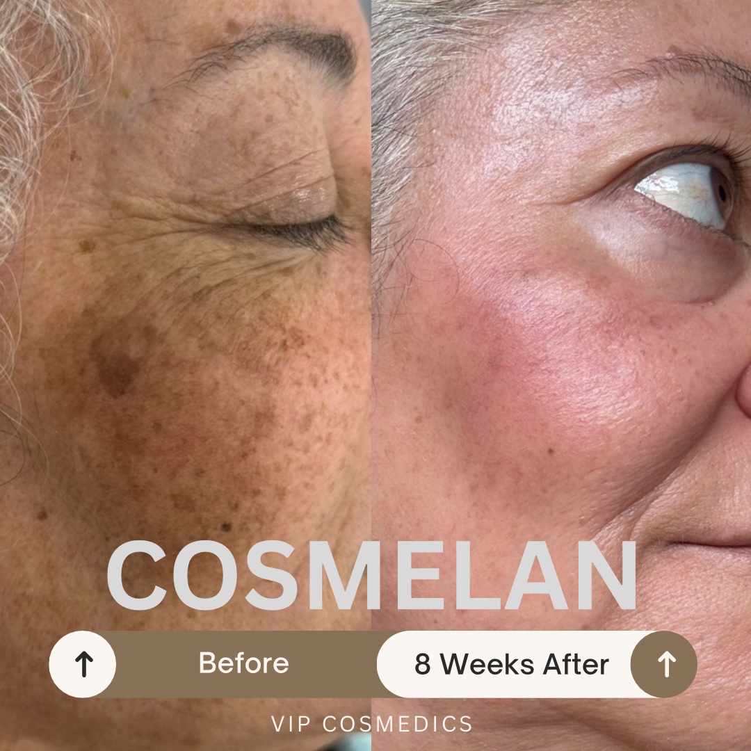 VIP Cosmedics client before Cosmelan and eight weeks after the programme